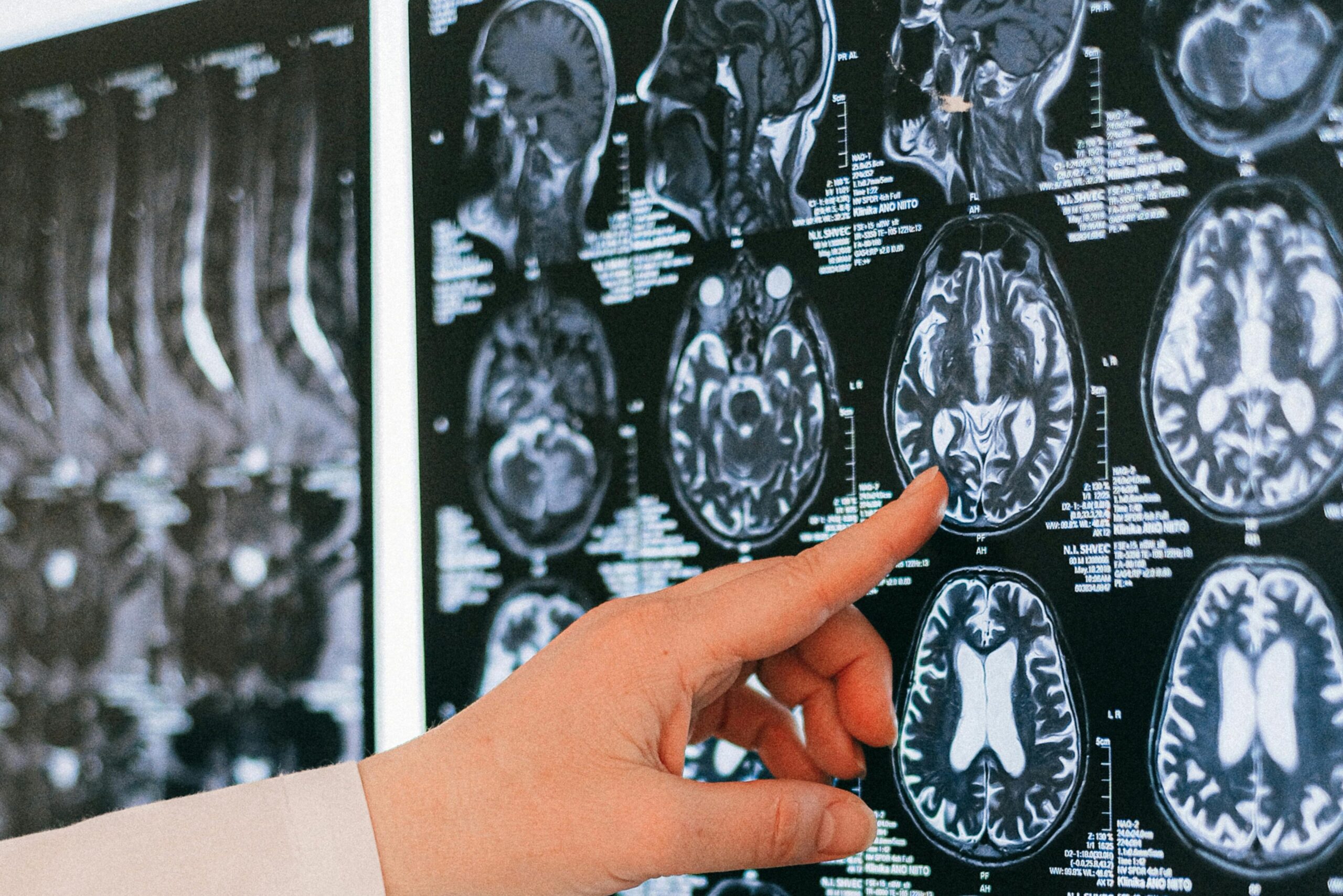 A doctor's hand points to a brain MRI scan on a lightbox, illustrating medical diagnosis.